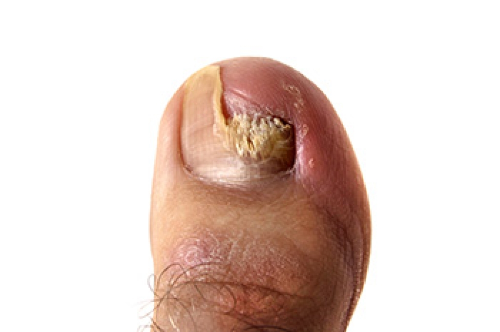 Dealing With Symptoms of Toenail Fungus