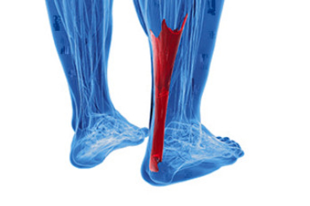 Achilles Tendon Injuries in Basketball Players