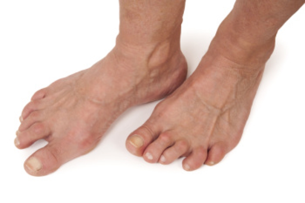 When Rheumatoid Arthritis Affects the Feet