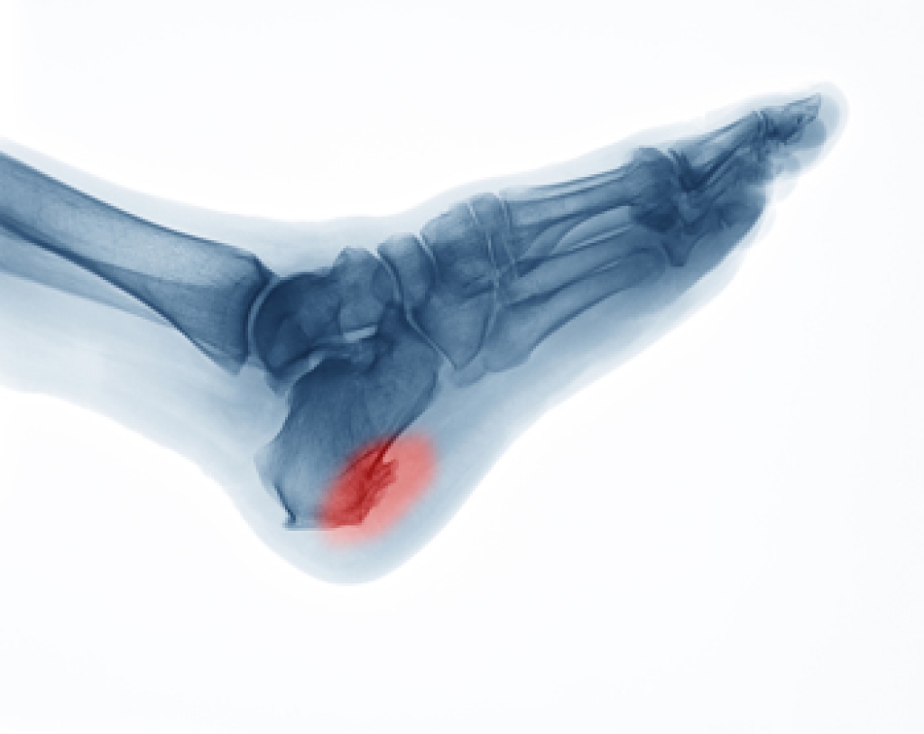 Treating Heel Spurs With Podiatric Care