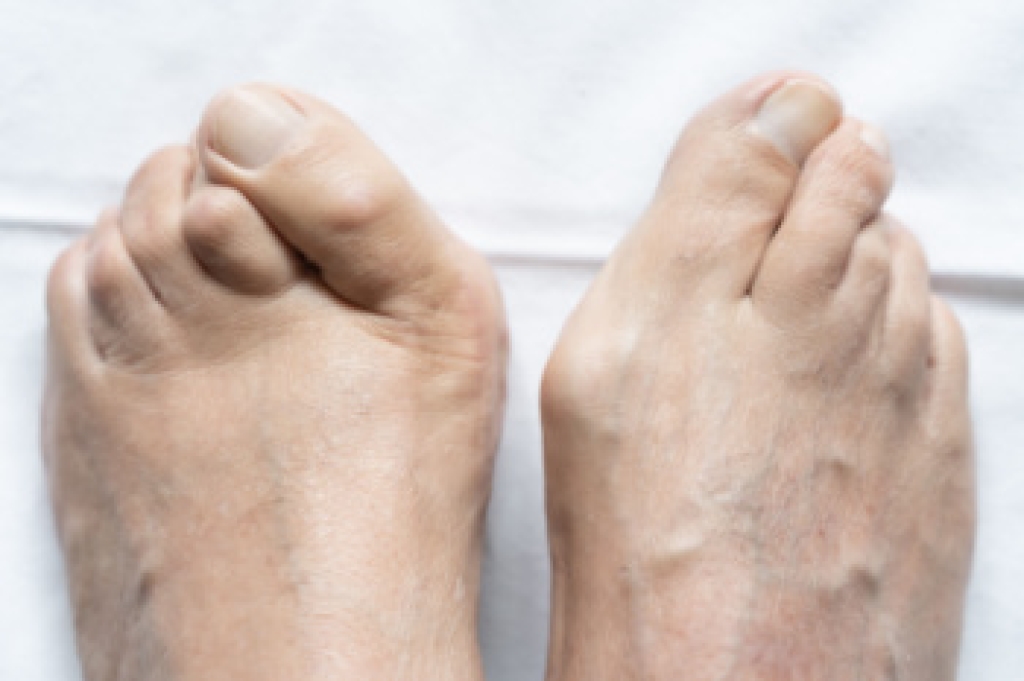 What Causes a Bump on the Big Toe?