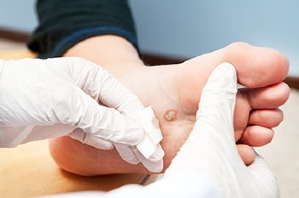 Painful Plantar Warts