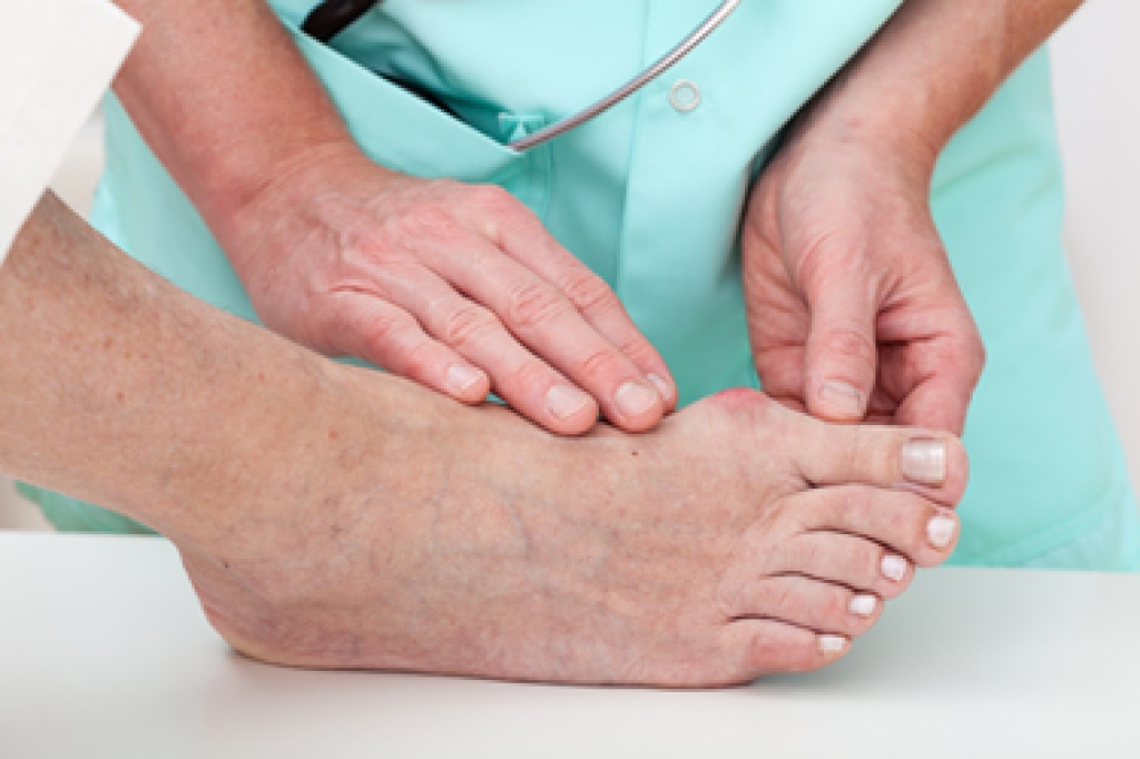 Treating and Managing Bunion Pain