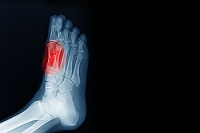 Sesamoiditis and Foot Pain