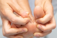 Symptoms and Treatment of Athlete’s Foot